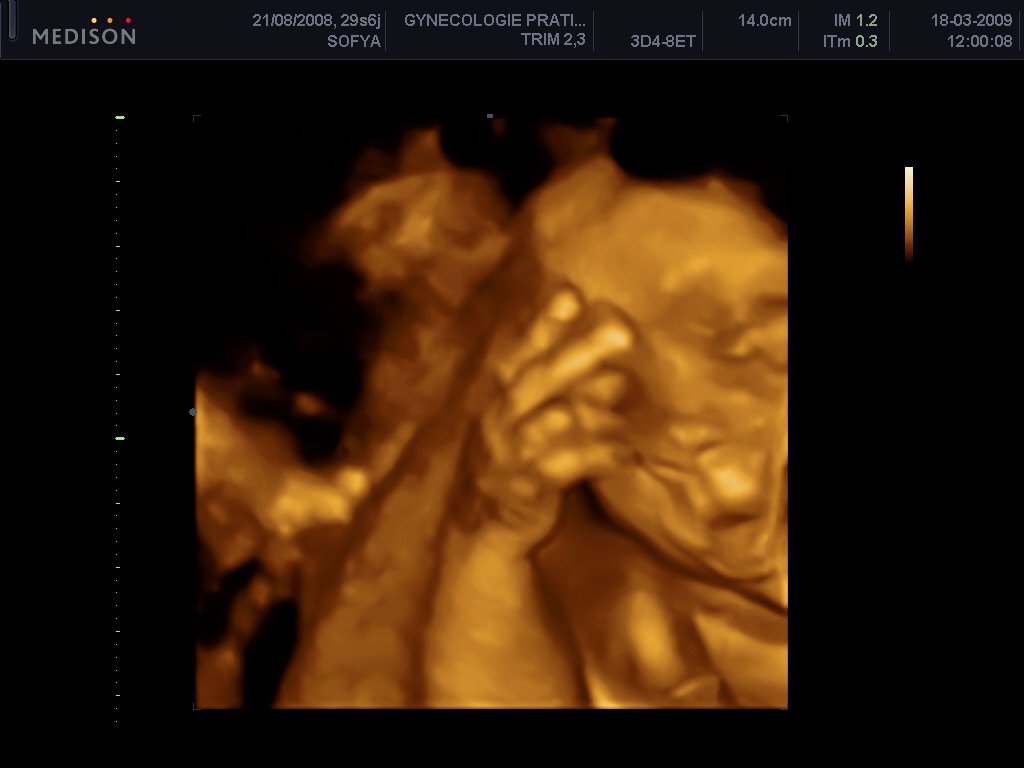 Echo 3d Photo Realiste Bebe Grandit Forum Grossesse Amp Bebe Doctissimo Echo 3d Photo Realiste Bebe Grandit Forum Grossesse Amp Bebe Doctissimo