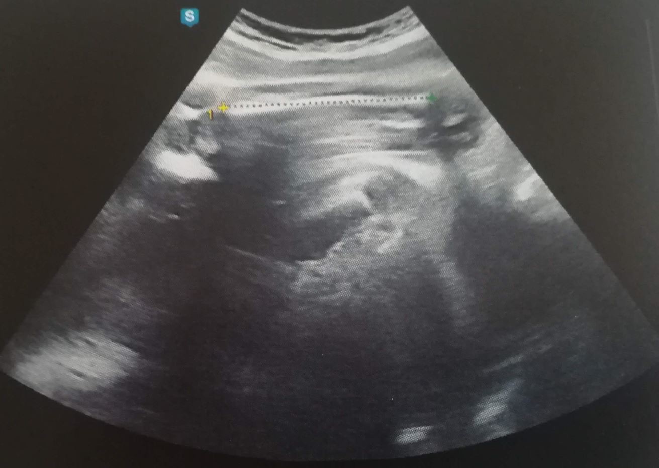 Avis Echographie 32sa Echographie Connaitre Le Sexe De Votre Bebe Forum Grossesse Amp Bebe Doctissimo