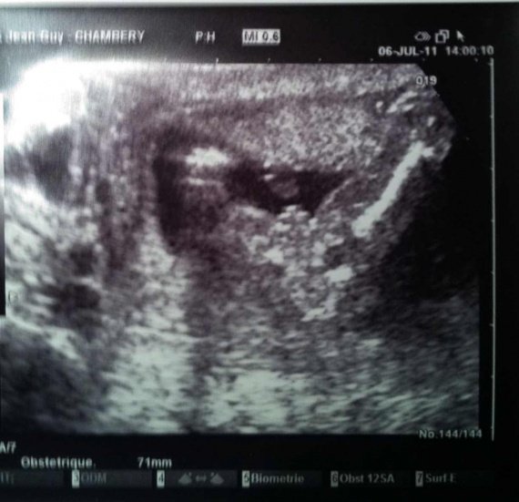 Entrejambe De Mon Bebe A 16 Sa Et 2j Votre Avis Entrejambe De Mon Bebe A 16 Sa Et 2j Votre Avis