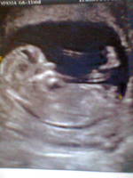 Echographie 1 bébé