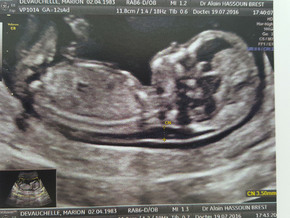 Clarte Nucale Epaisse