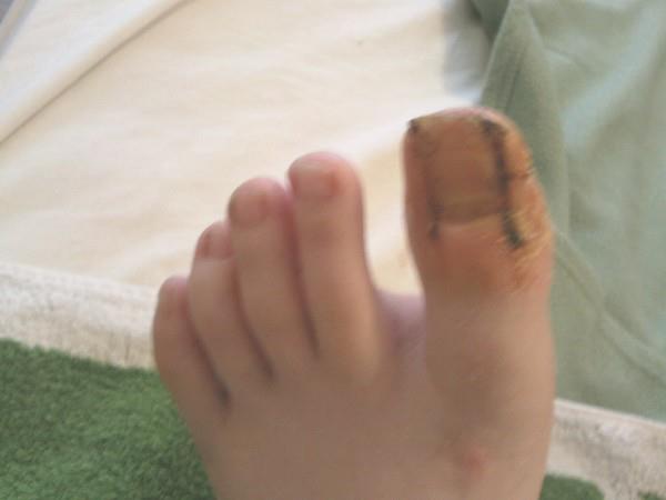 Operation Du Gros Orteil Incarne A 13 Ans Evolution Et Suivi Photos Sante De L Enfant Forum Sante Doctissimo