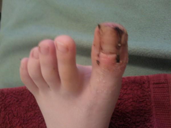 Operation Du Gros Orteil Incarne A 13 Ans Evolution Et Suivi Photos Sante De L Enfant Forum Sante Doctissimo Operation Du Gros Orteil Incarne A 13 Ans Evolution Et Suivi Photos Sante De L Enfant Forum Sante Doctissimo