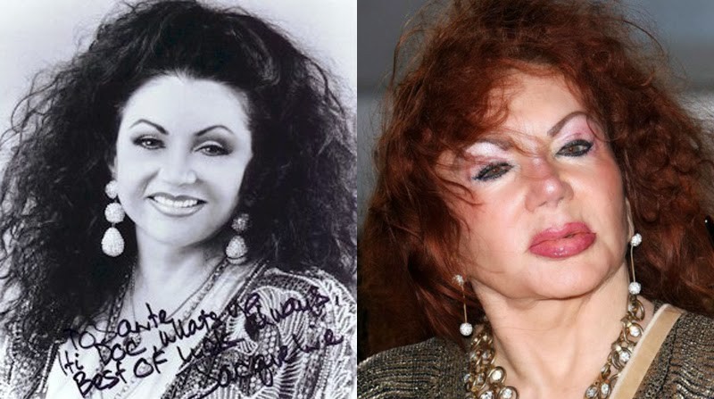 Jackie Stallone avant et apres chirurgie esthétique pire ...