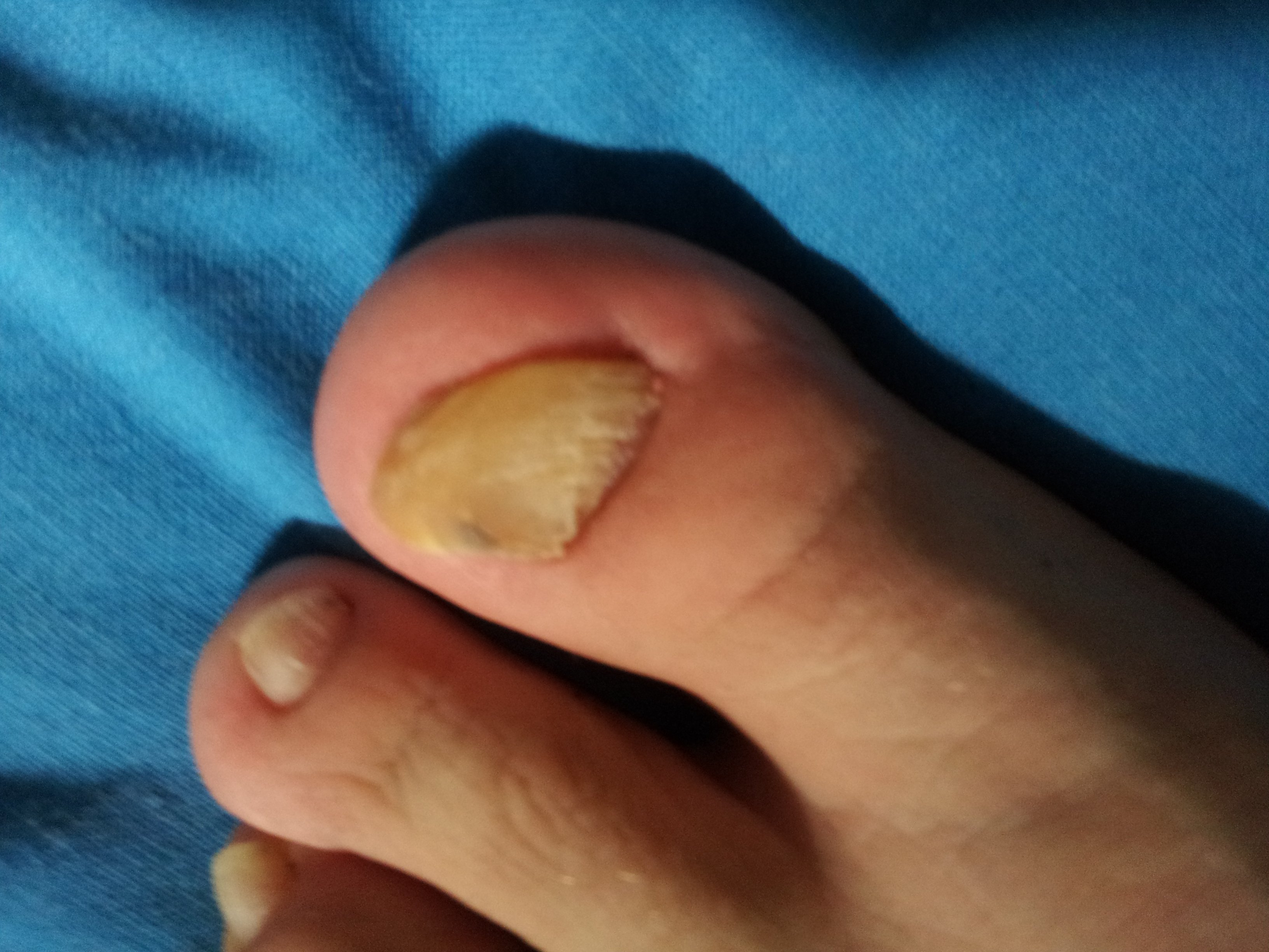 Probleme Avec Mon Ongle Du Gros Orteil Depuis 7 Ans Mycoses Forum Sante Doctissimo Probleme Avec Mon Ongle Du Gros Orteil Depuis 7 Ans Mycoses Forum Sante Doctissimo