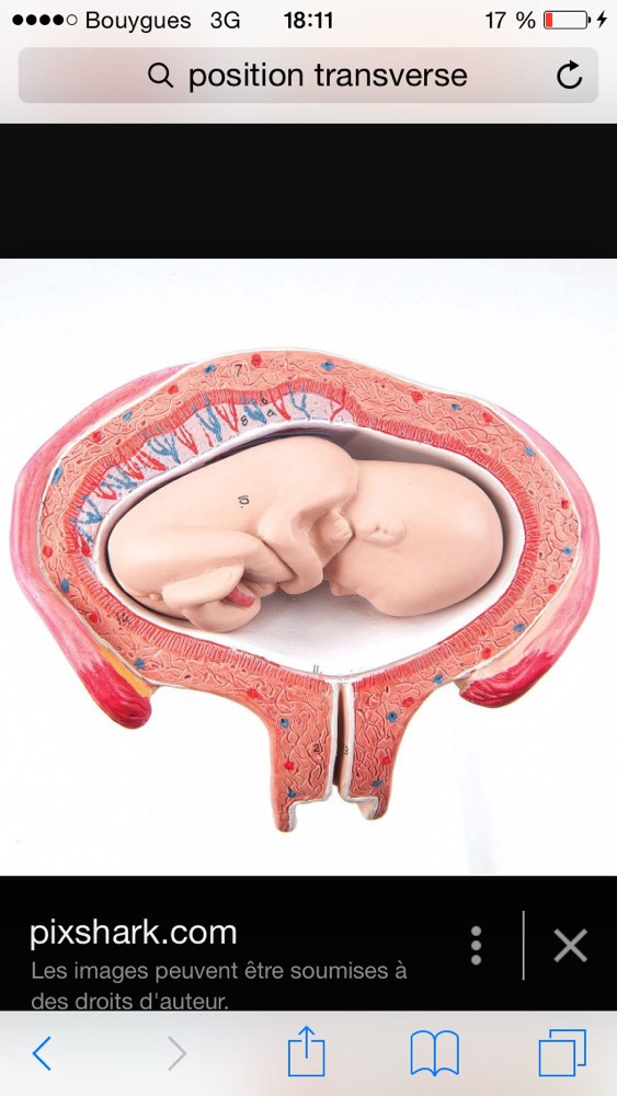 Version Manoeuvre Externe Futures Mamans Forum Grossesse Amp Bebe Doctissimo Version Manoeuvre Externe Futures Mamans Forum Grossesse Amp Bebe Doctissimo