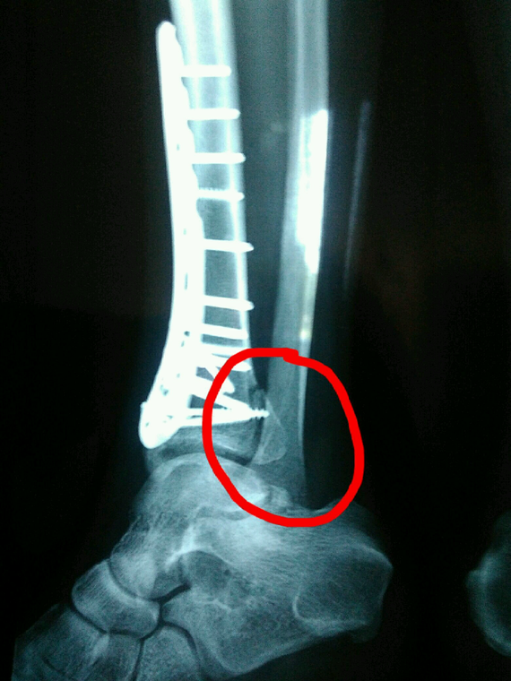 Fracture du péroné et question