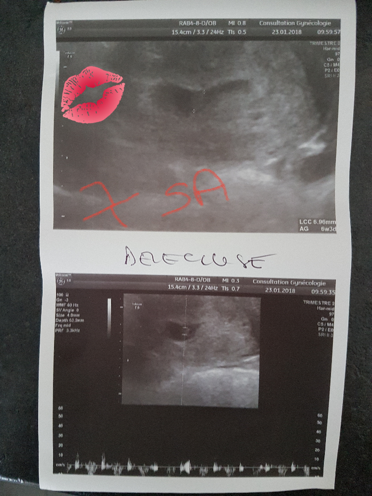 Echographie 6 Semaines Echographie Connaitre Le Sexe De Votre Bebe Forum Grossesse Amp Bebe Doctissimo Echographie 6 Semaines Echographie Connaitre Le Sexe De Votre Bebe Forum Grossesse Amp Bebe Doctissimo