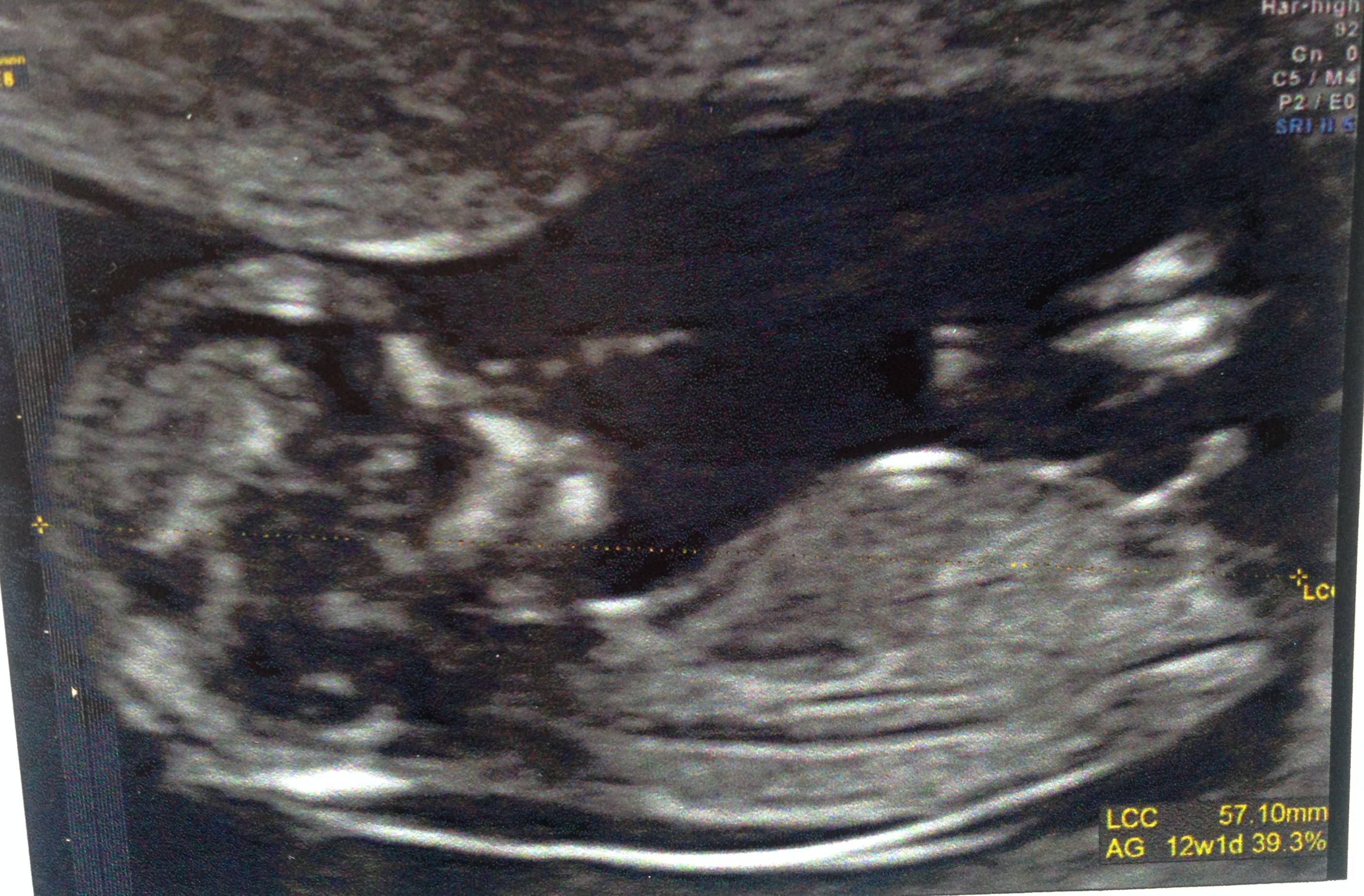 Petite Question Sur Le Bourgeon Tubercule Genitale Echographie Connaitre Le Sexe De Votre Bebe Forum Grossesse Amp Bebe Doctissimo Petite Question Sur Le Bourgeon Tubercule Genitale Echographie Connaitre Le Sexe De Votre Bebe Forum Grossesse Amp Bebe Doctissimo