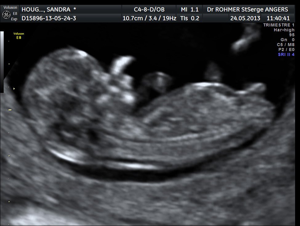Fille Garcon D Autre Avis Echographie Connaitre Le Sexe De Votre Bebe Forum Grossesse Amp Bebe Doctissimo Fille Garcon D Autre Avis Echographie Connaitre Le Sexe De Votre Bebe Forum Grossesse Amp Bebe Doctissimo