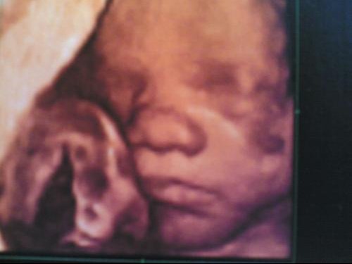 Les Plus Selectionnes Echographie 3d Bebe Gros Nez Elcampodelamentiraa Les Plus Selectionnes Echographie 3d Bebe Gros Nez Elcampodelamentiraa