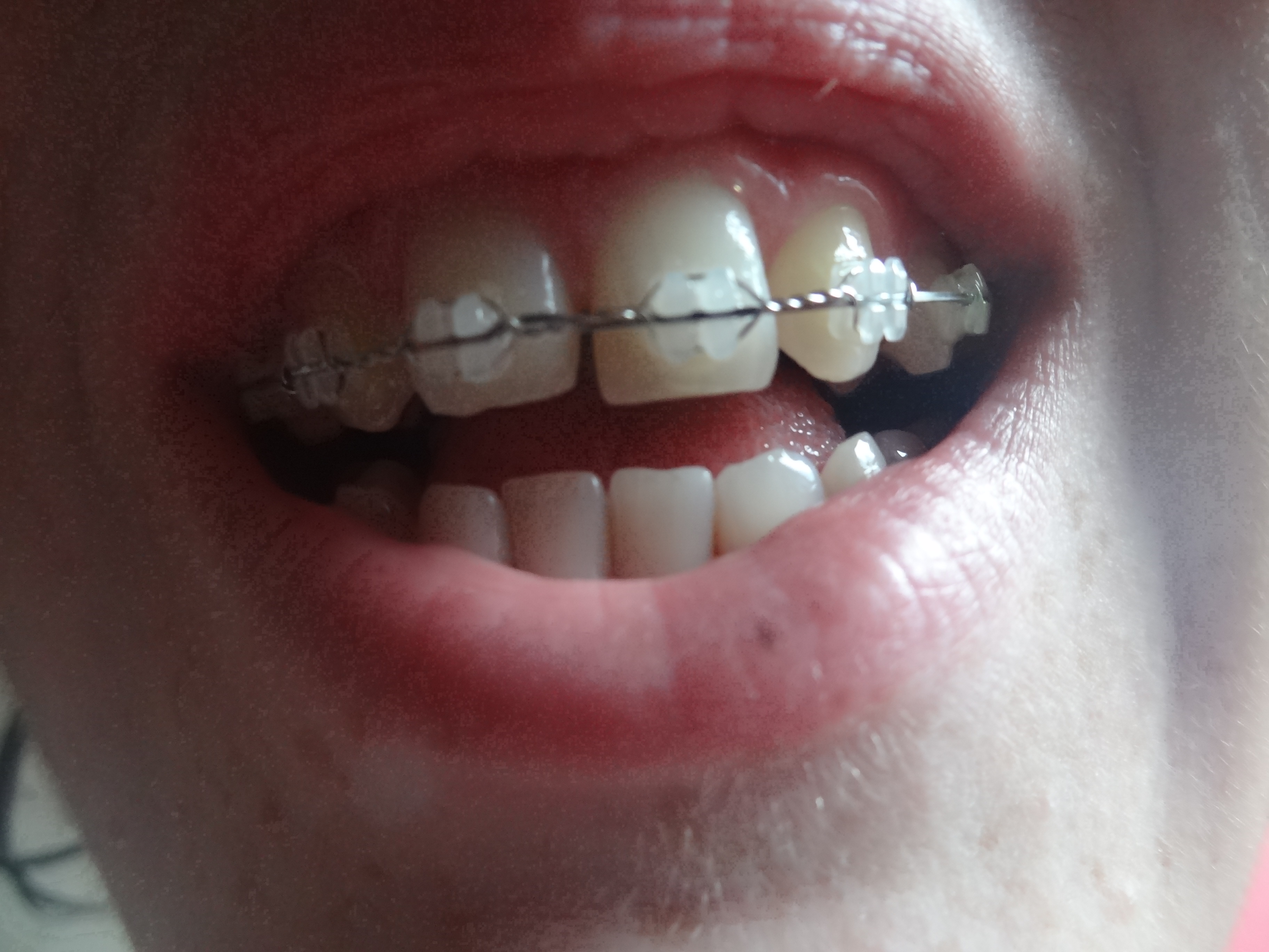 Dents Cassee A Cause De Mon Appareil Dentaire Problemes