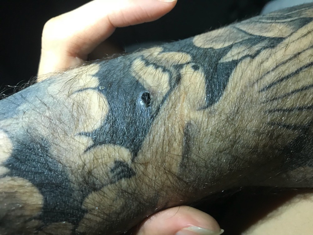 boutons sur tatouage ! - acné, psoriasis et problèmes de peau