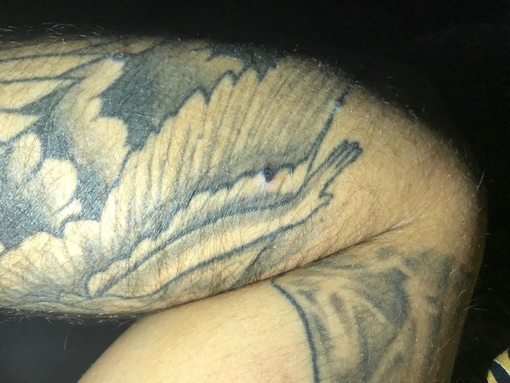 boutons sur tatouage ! - acné, psoriasis et problèmes de peau