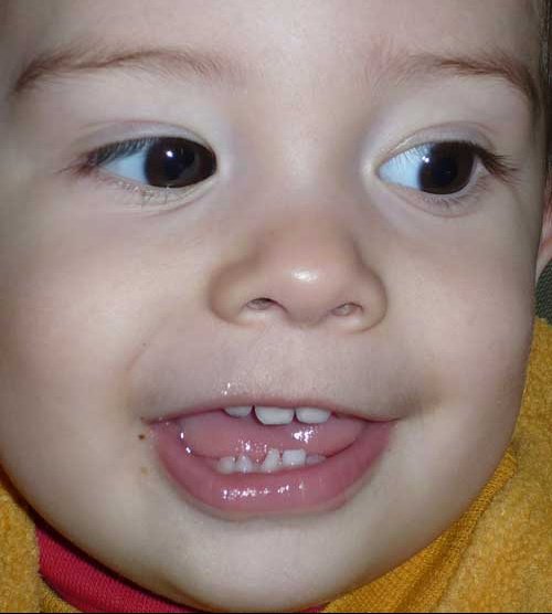 Dent De Lait Qui Pousse En 2 Morceaux