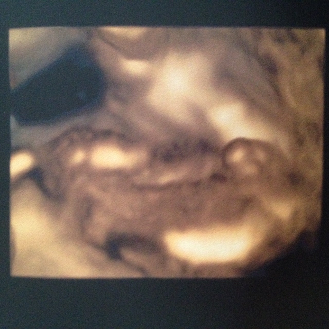 Amnio A 32 Cause Hypospadias Besoin De Conseil Amniocentese Forum Grossesse Amp Bebe Doctissimo Amnio A 32 Cause Hypospadias Besoin De Conseil Amniocentese Forum Grossesse Amp Bebe Doctissimo