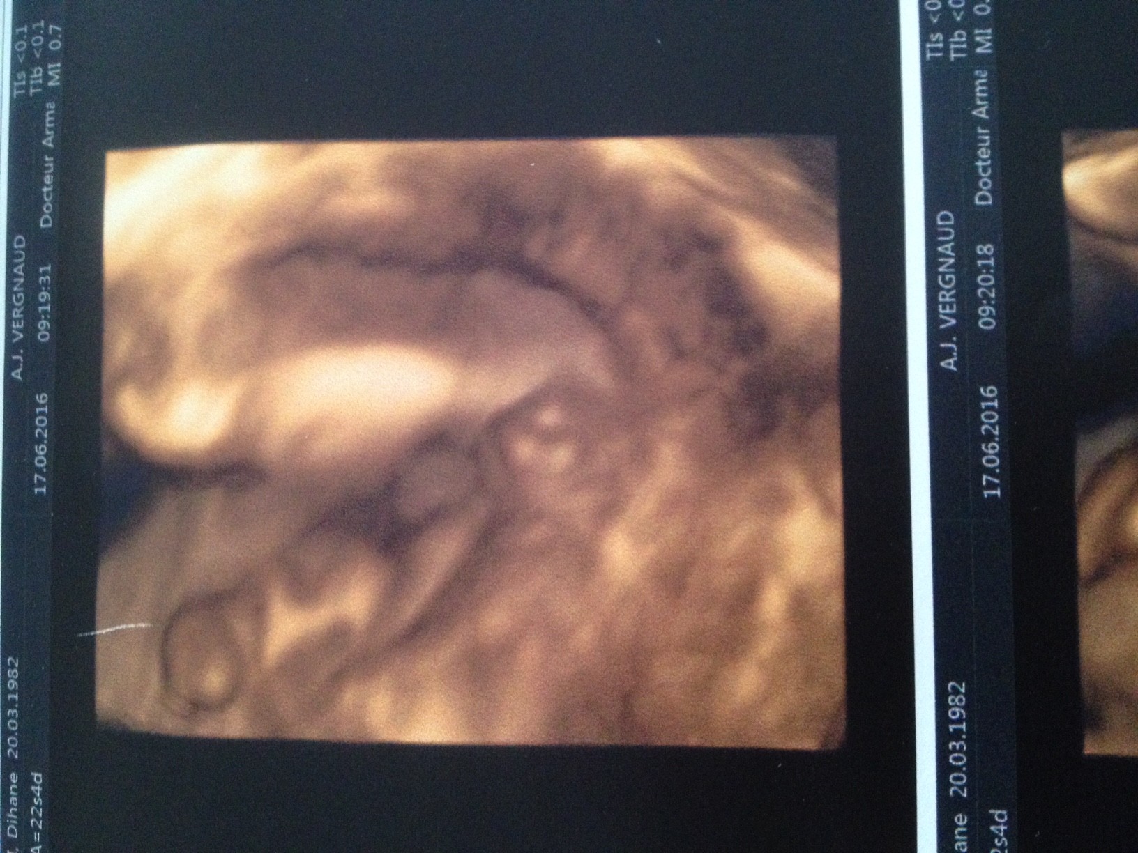 Echo 22 Semaine Sexe Ambigue Echographie Connaitre Le Sexe De Votre Bebe Forum Grossesse Amp Bebe Doctissimo Echo 22 Semaine Sexe Ambigue Echographie Connaitre Le Sexe De Votre Bebe Forum Grossesse Amp Bebe Doctissimo