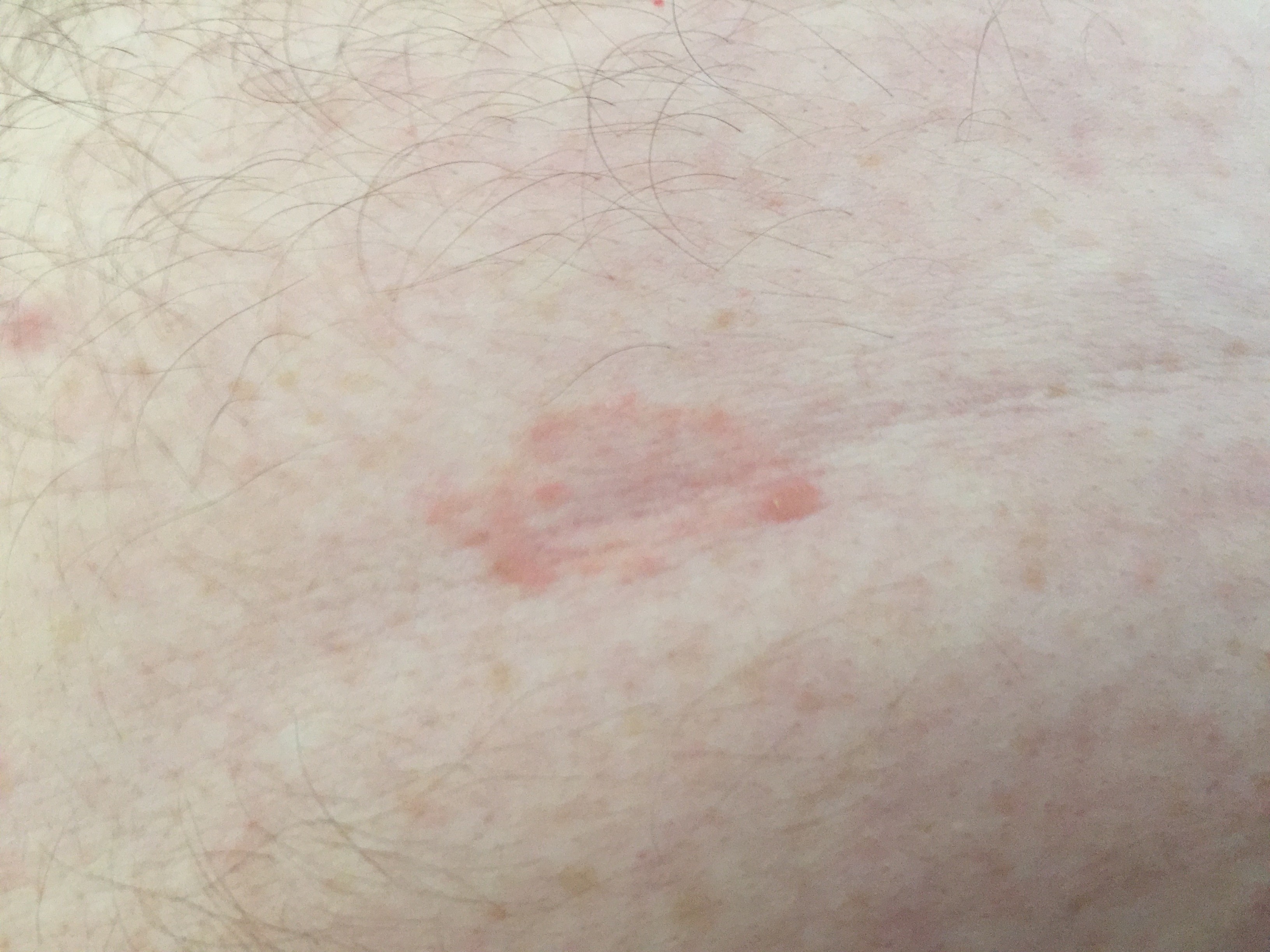 Une Tache Rose Sur Mon Ventre Forum Libre Sante Forum Sante