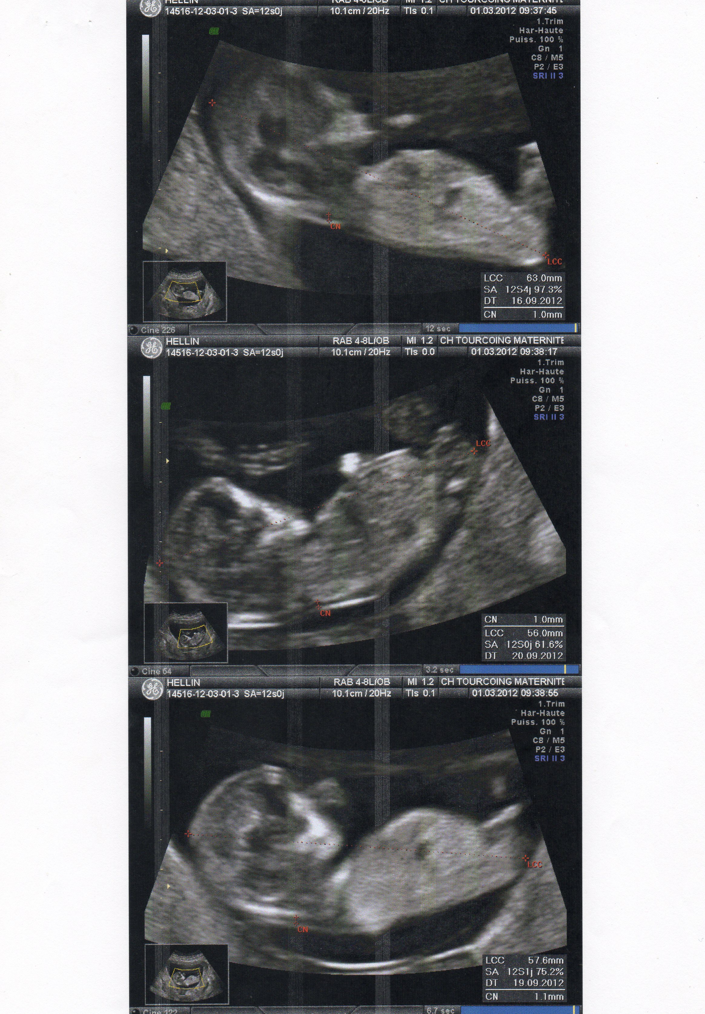 Echo Des 12sa Page 4 Futures Mamans Forum Grossesse Amp Bebe Doctissimo