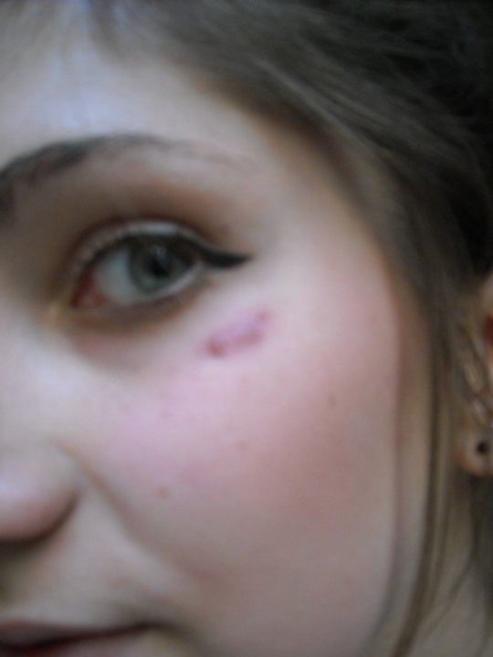 Piercing Enleve Apres Infections Tatouages Et Piercings Forum Beaute Doctissimo Piercing Enleve Apres Infections Tatouages Et Piercings Forum Beaute Doctissimo