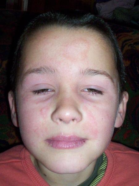Mais qu'est ce qu'il a ???? - Allergies et eczéma - FORUM Santé ...
