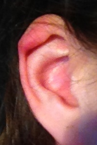 Oreille Pliee Chirurgie Esthetique Forum Beaute Doctissimo Oreille Pliee Chirurgie Esthetique Forum Beaute Doctissimo