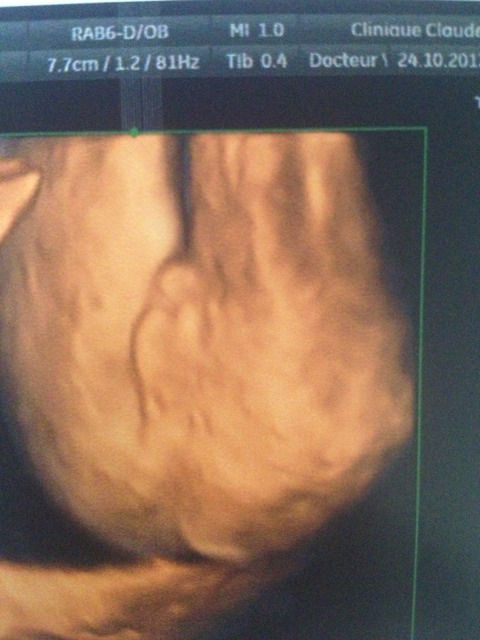 Besoin D Aide Sece Bebe A L Echo Des 22sa 2j Echographie Connaitre Le Sexe De Votre Bebe Forum Grossesse Amp Bebe Doctissimo Besoin D Aide Sece Bebe A L Echo Des 22sa 2j Echographie Connaitre Le Sexe De Votre Bebe Forum Grossesse Amp Bebe Doctissimo