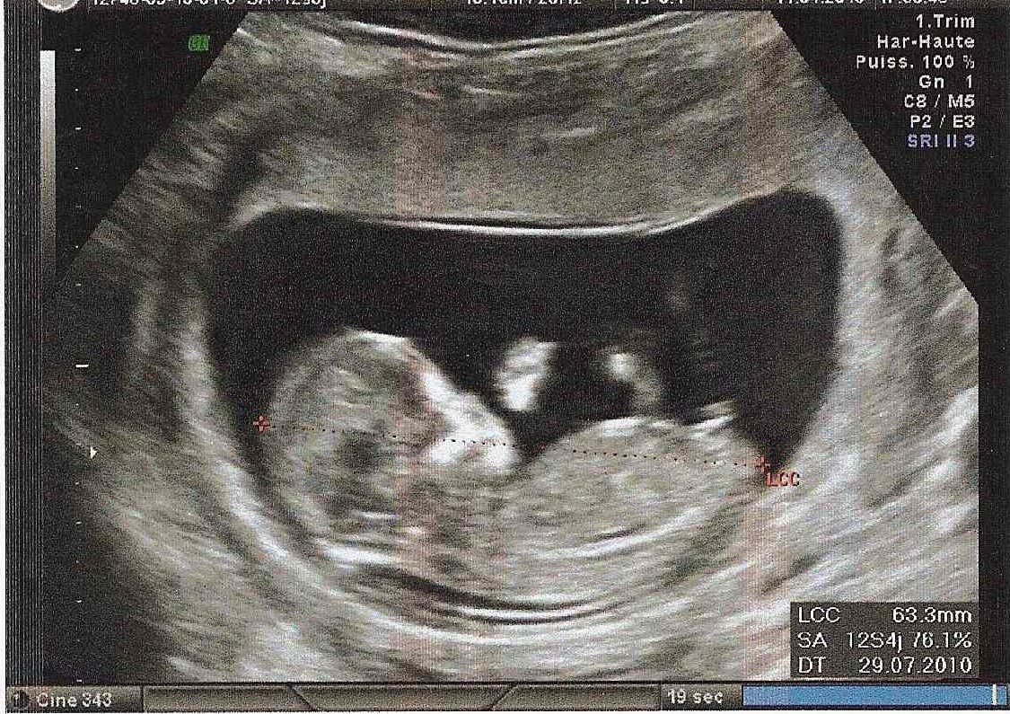 Mon Echo A 12 Sem 3 Fille Ou Garcon A Vos Avis Echographie Connaitre Le Sexe De Votre Bebe Forum Grossesse Amp Bebe Doctissimo Mon Echo A 12 Sem 3 Fille Ou Garcon A Vos Avis Echographie Connaitre Le Sexe De Votre Bebe Forum Grossesse Amp Bebe Doctissimo