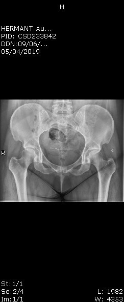 Radio Bassin Arthrose Et Problemes Osteo Articulaires Forum Sante Doctissimo Radio Bassin Arthrose Et Problemes Osteo Articulaires Forum Sante Doctissimo