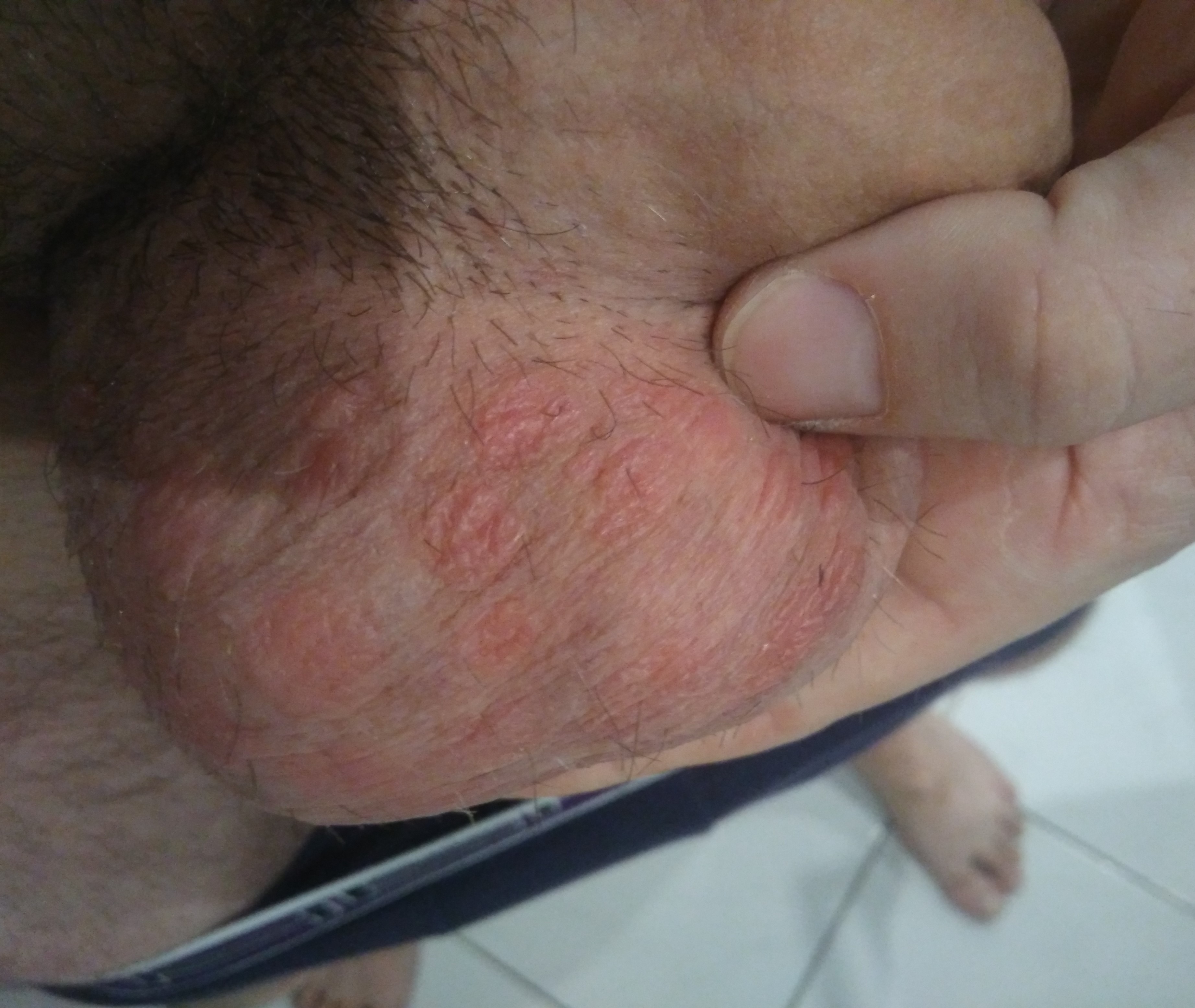 Plaques Rouge Sur Les Bourses Et Penis Acne Psoriasis Et Problemes De Peau Forum Sante Doctissimo Plaques Rouge Sur Les Bourses Et Penis Acne Psoriasis Et Problemes De Peau Forum Sante Doctissimo