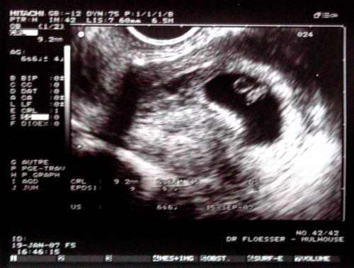 Echographie A 5 5 Sa Echographie Connaitre Le Sexe De Votre Bebe Forum Grossesse Amp Bebe Doctissimo