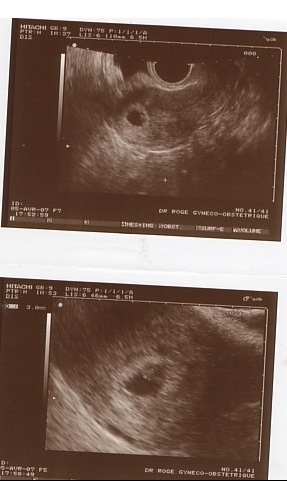 Que Pensez Vous De Mon Echo De 4 Semaines Echographie Connaitre Le Sexe De Votre Bebe Forum Grossesse Amp Bebe Doctissimo Que Pensez Vous De Mon Echo De 4 Semaines Echographie Connaitre Le Sexe De Votre Bebe Forum Grossesse Amp Bebe Doctissimo