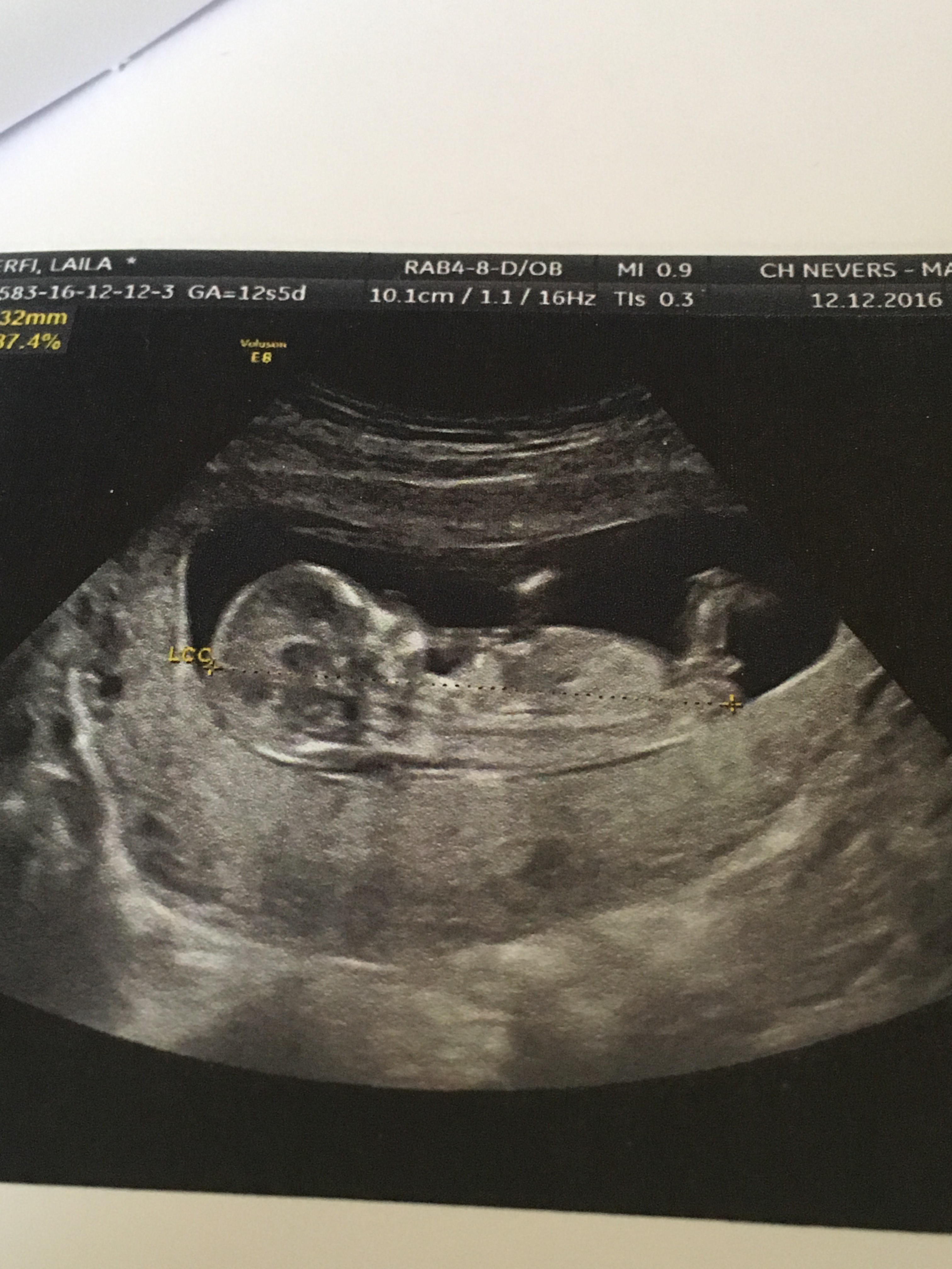 Echo 12 Sa 5 Jours Echographie Connaitre Le Sexe De Votre Bebe Forum Grossesse Amp Bebe Doctissimo Echo 12 Sa 5 Jours Echographie Connaitre Le Sexe De Votre Bebe Forum Grossesse Amp Bebe Doctissimo