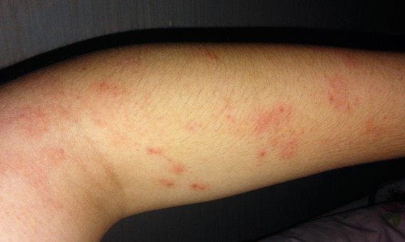 Plaques rouges sur les avant-bras - Eczéma - Acné, psoriasis et