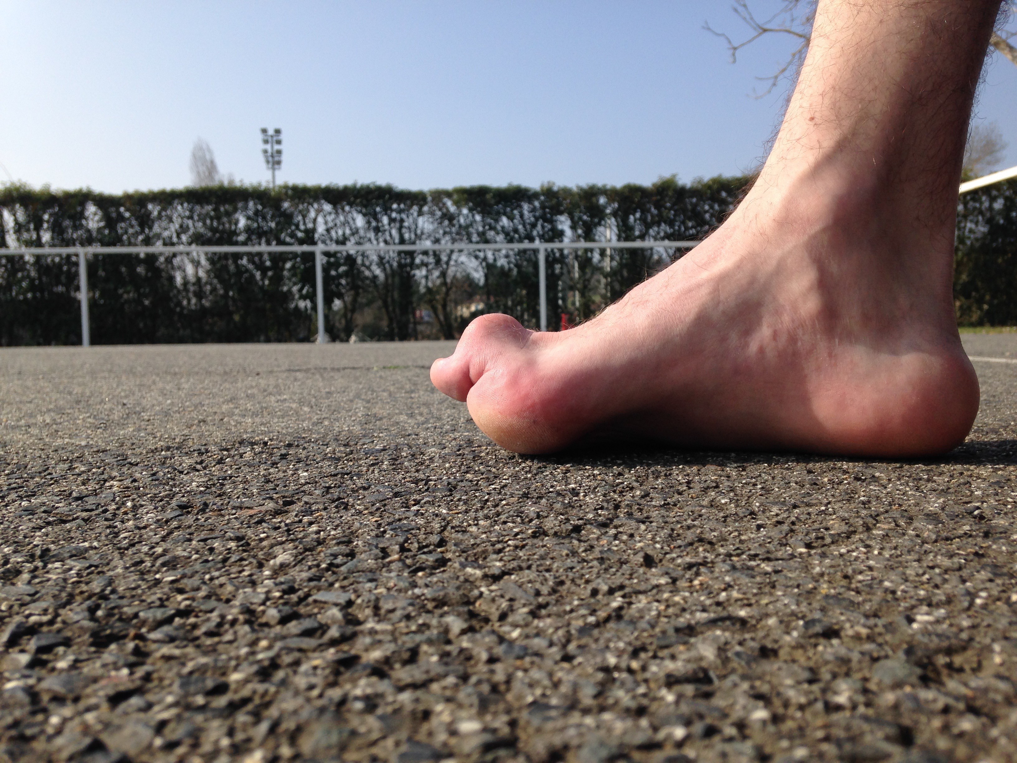 pics Maladie De Charcot-Marie-Tooth Temoignage charcot marie tooth maladies