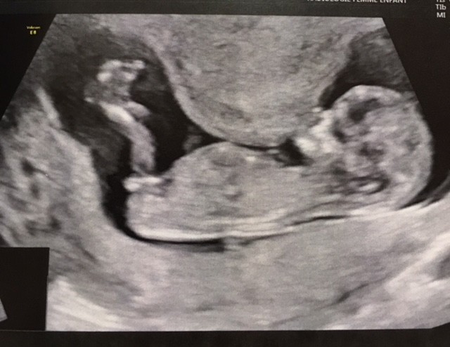 Echo 12sa 4 Le Verdict Echographie Connaitre Le Sexe De Votre Bebe Forum Grossesse Amp Bebe Doctissimo Echo 12sa 4 Le Verdict Echographie Connaitre Le Sexe De Votre Bebe Forum Grossesse Amp Bebe Doctissimo