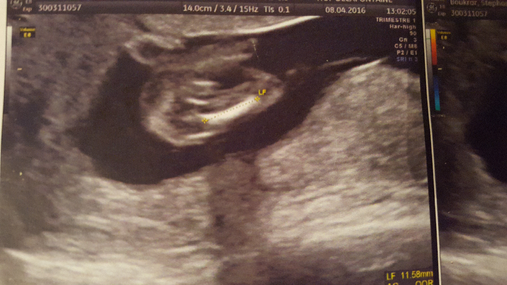 Echographie 14 Sa Une Idee Fille Ou Garcon Echographie Connaitre Le Sexe De Votre Bebe Forum Grossesse Amp Bebe Doctissimo Echographie 14 Sa Une Idee Fille Ou Garcon Echographie Connaitre Le Sexe De Votre Bebe Forum Grossesse Amp Bebe Doctissimo