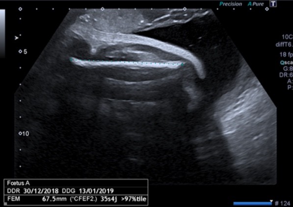 Doute Sexe 32sa Echographie Connaitre Le Sexe De Votre Bebe Forum Grossesse Amp Bebe Doctissimo