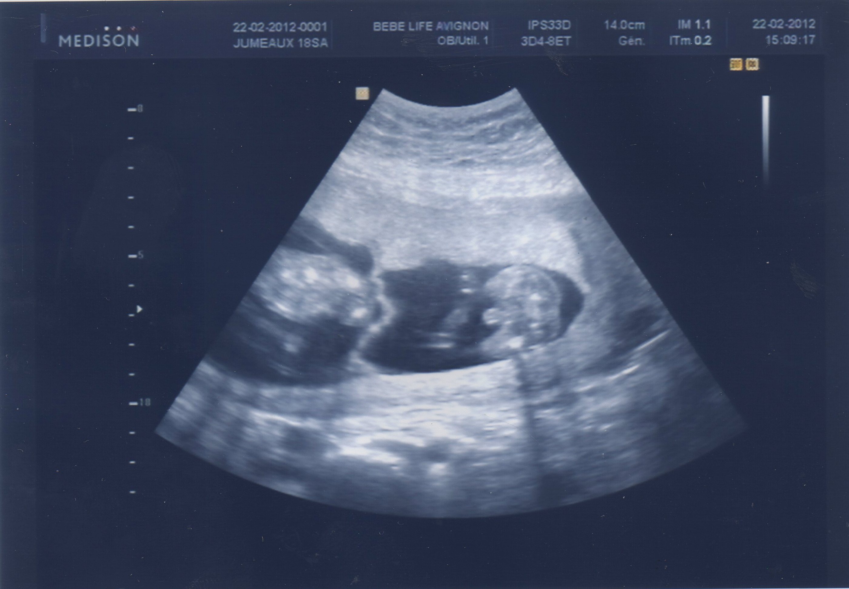 Sexe Jumeaux 17sa 5 Echographie Connaitre Le Sexe De Votre Bebe Forum Grossesse Amp Bebe Doctissimo Sexe Jumeaux 17sa 5 Echographie Connaitre Le Sexe De Votre Bebe Forum Grossesse Amp Bebe Doctissimo