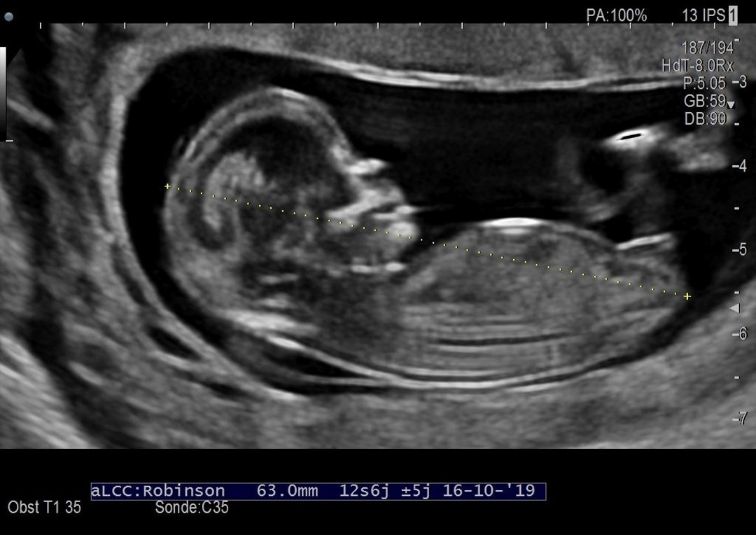 Avis Sexe Echo 12sa 4 Echographie Connaitre Le Sexe De Votre Bebe Forum Grossesse Amp Bebe Doctissimo Avis Sexe Echo 12sa 4 Echographie Connaitre Le Sexe De Votre Bebe Forum Grossesse Amp Bebe Doctissimo