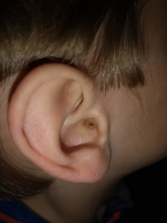 Probleme Oreille Enfant Photos Acne Psoriasis Et Problemes De Peau Forum Sante Doctissimo Probleme Oreille Enfant Photos Acne Psoriasis Et Problemes De Peau Forum Sante Doctissimo