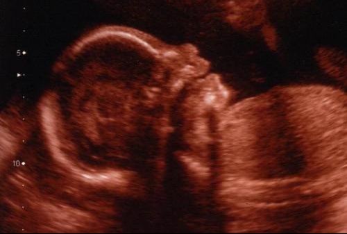 Mes Cliches Echo Morpho Futures Mamans Forum Grossesse Amp Bebe Doctissimo