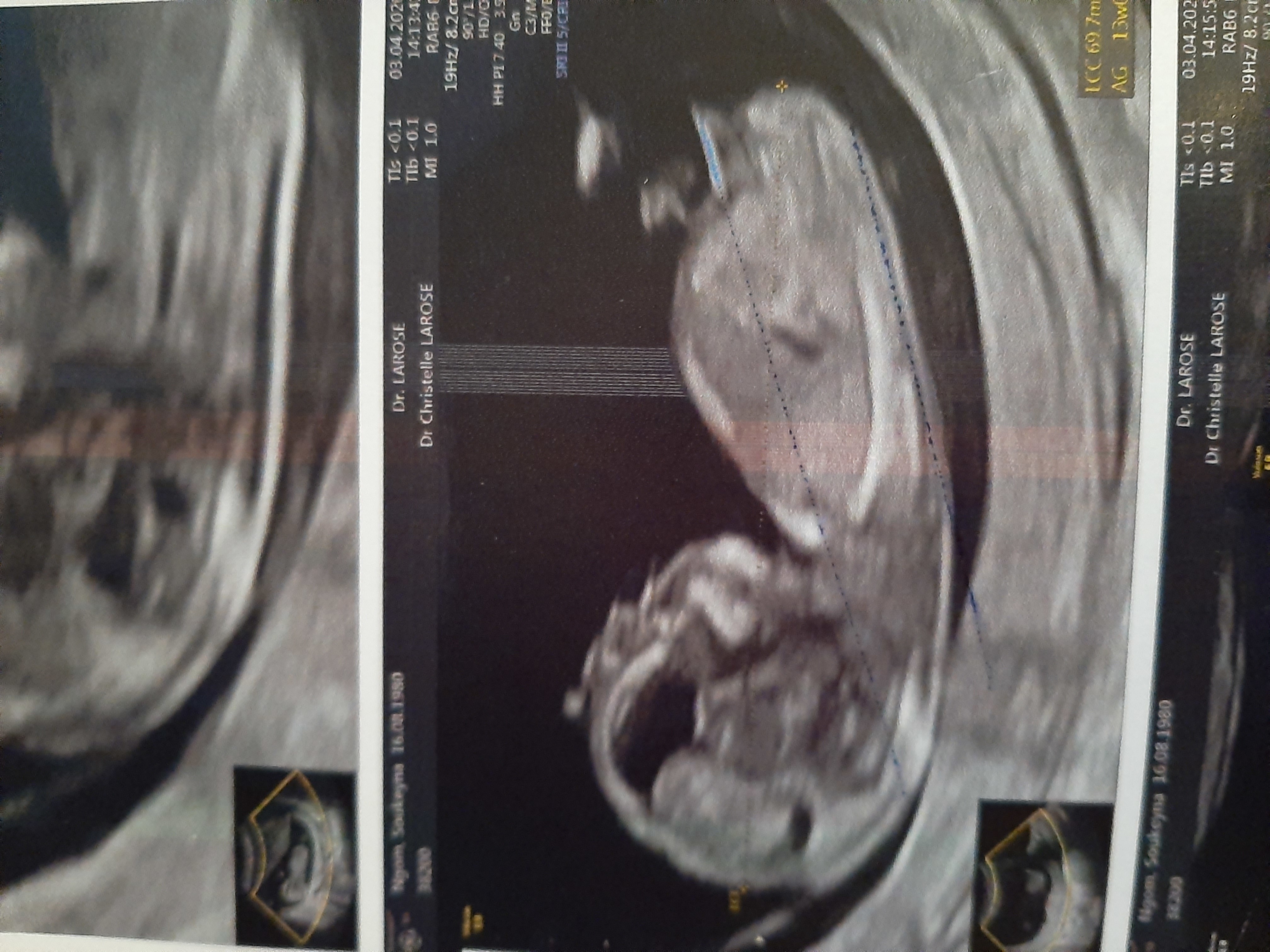 Echographie 13 Sa Fille Ou Garcon Echographie Connaitre Le Sexe De Votre Bebe Forum Grossesse Amp Bebe Doctissimo