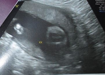 26 Sa Sexe Pas Encore Differencie Echographie Connaitre Le Sexe De Votre Bebe Forum Grossesse Amp Bebe Doctissimo 26 Sa Sexe Pas Encore Differencie Echographie Connaitre Le Sexe De Votre Bebe Forum Grossesse Amp Bebe Doctissimo