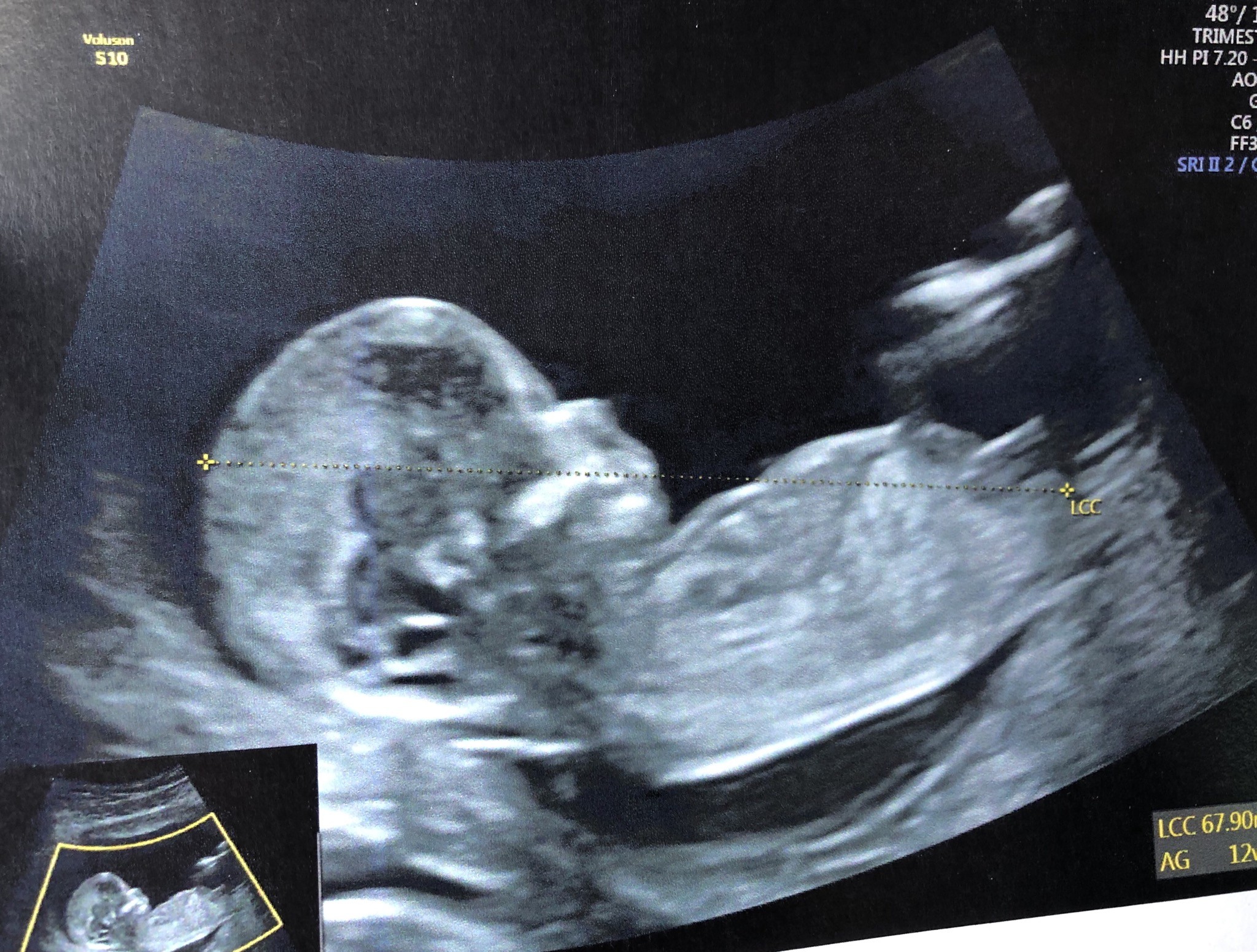 Avis Sexe Bebe 12 6 Semaines Echographie Connaitre Le Sexe De Votre Bebe Forum Grossesse Amp Bebe Doctissimo Avis Sexe Bebe 12 6 Semaines Echographie Connaitre Le Sexe De Votre Bebe Forum Grossesse Amp Bebe Doctissimo