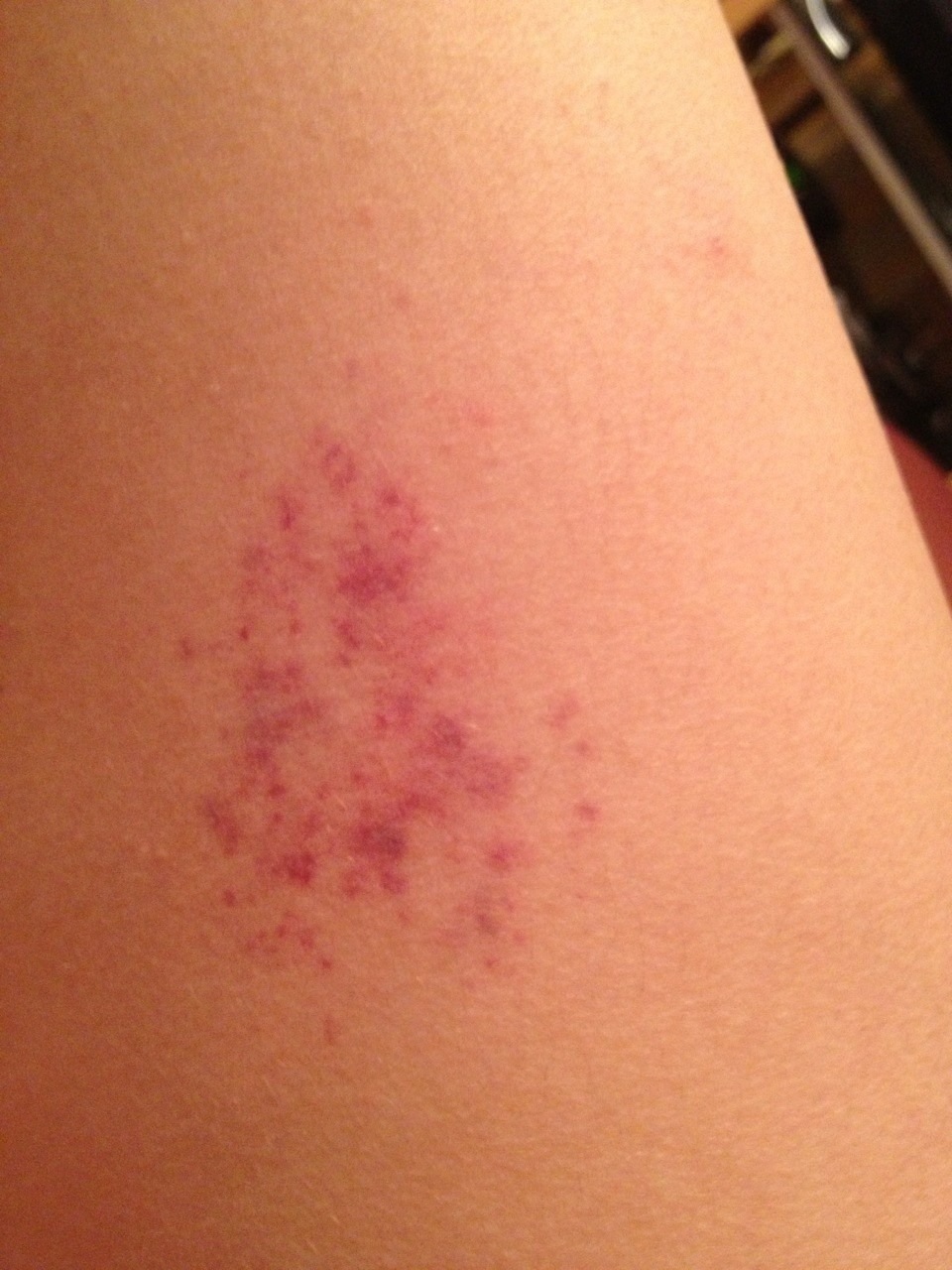 taches violettes sur la cuisse forum libre sante forum sante doctissimo