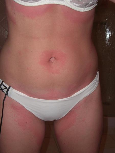 C Est Un Urticaire Geant J Ai Les Photos Bebe Grandit Forum Grossesse Amp Bebe Doctissimo C Est Un Urticaire Geant J Ai Les Photos Bebe Grandit Forum Grossesse Amp Bebe Doctissimo