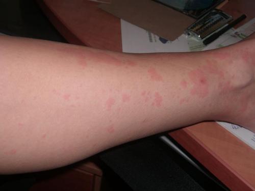 C Est Un Urticaire Geant J Ai Les Photos Page 2 Bebe Grandit Forum Grossesse Amp Bebe Doctissimo C Est Un Urticaire Geant J Ai Les Photos Page 2 Bebe Grandit Forum Grossesse Amp Bebe Doctissimo