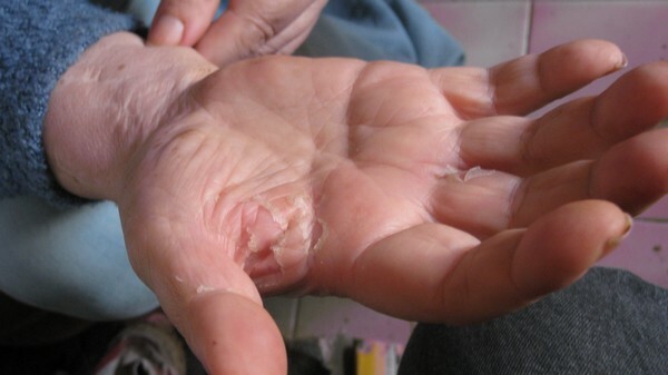 Peau Des Doigts Qui Pele Page 3 Forum Libre Sante Forum Sante Doctissimo Peau Des Doigts Qui Pele Page 3 Forum Libre Sante Forum Sante Doctissimo