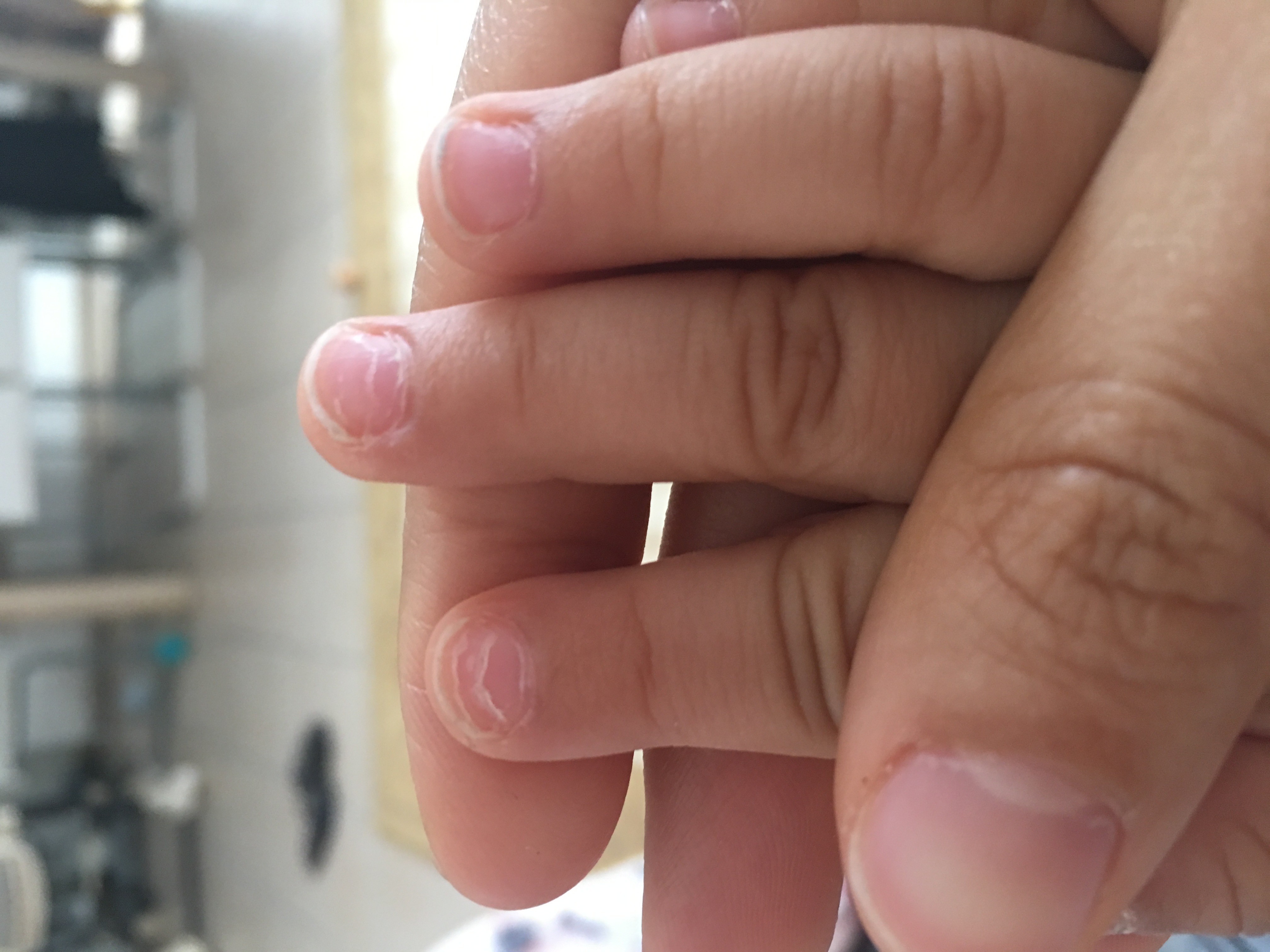 Bebe 15 Mois Avec Ongles Des Mains Stries Sante De L Enfant Forum Sante Doctissimo Bebe 15 Mois Avec Ongles Des Mains Stries Sante De L Enfant Forum Sante Doctissimo